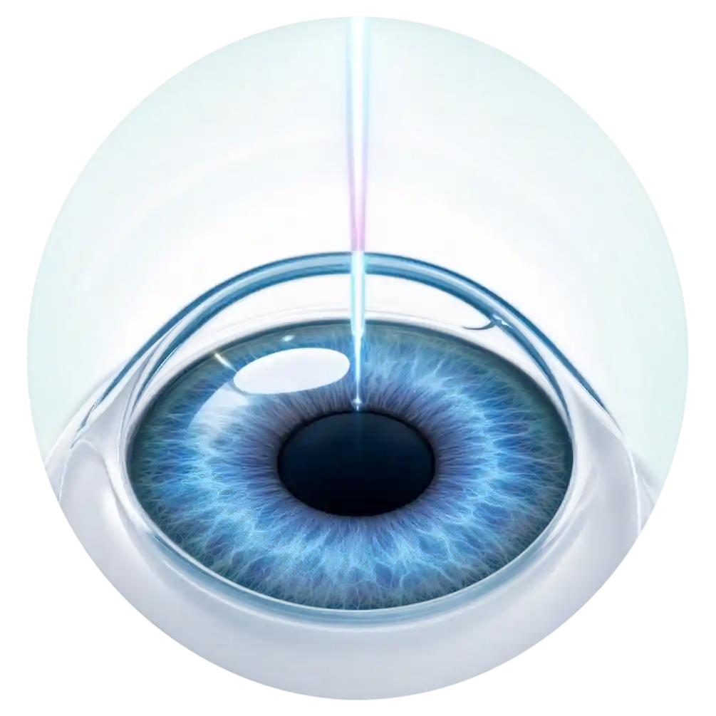 SMILE laser eye procedure
